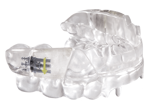 Clear oral appliance against white background