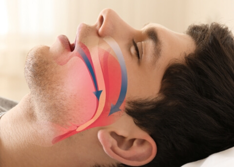 Man sleeping on his back with illustration of his blocked airway