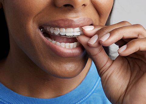 Close up of person placing an oral appliance over their teeth