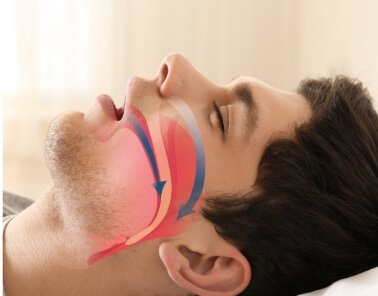 Man sleeping on his back with illustration of his blocked airway