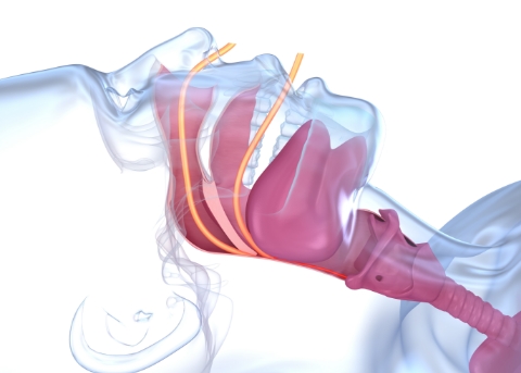 Illustrated of person sleeping on their back with their airway blocked